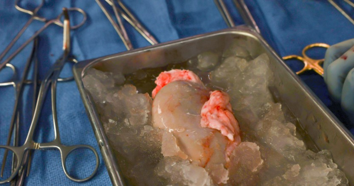 Пациент с ГМ-почкой свиньи умер спустя два месяца после трансплантации